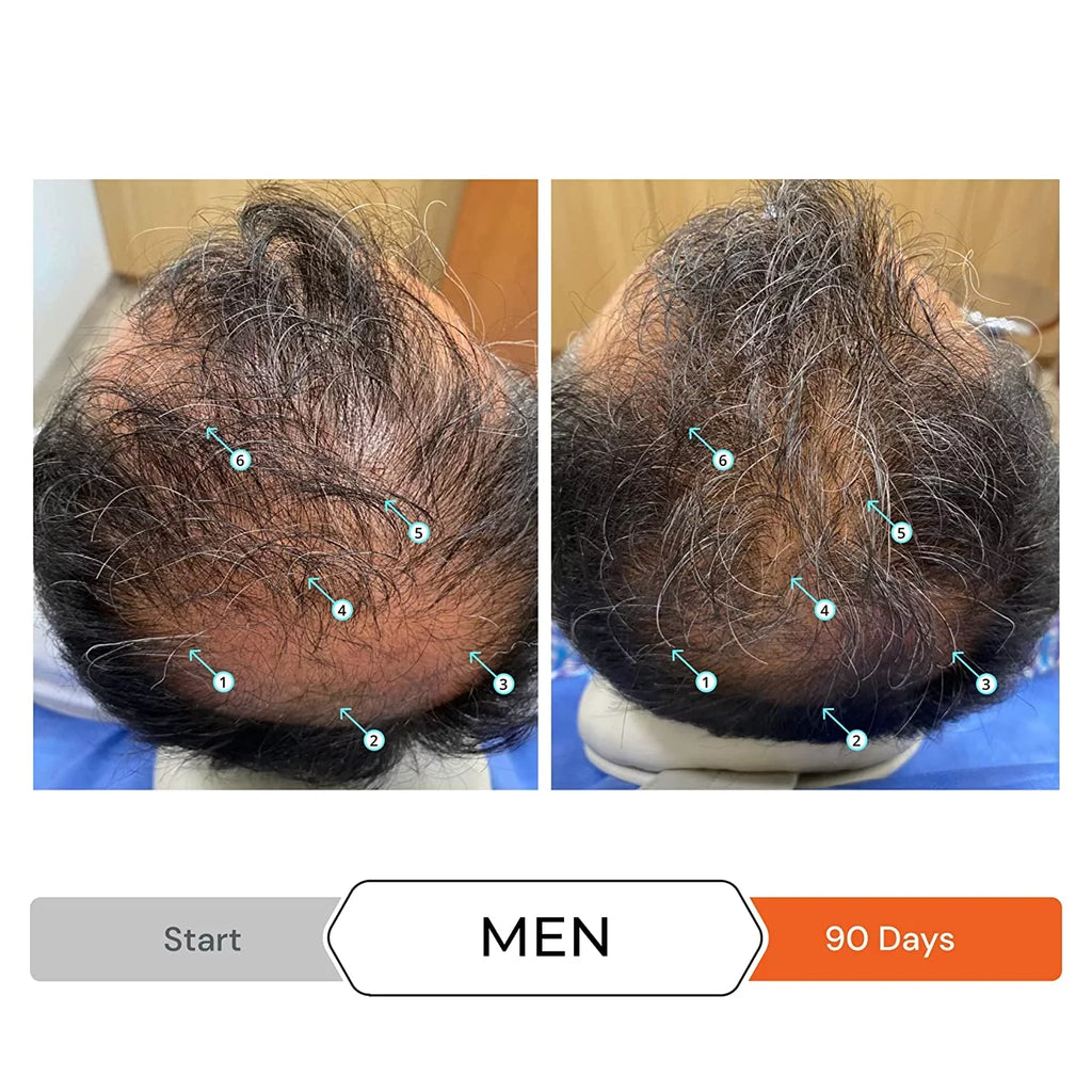 Revita Shampoo w/Biotin, Caffeine and Hair Growth Stimulating Ingredients, Helps Block DHT w/DNC-N Nanoxidil 5% Hair Regrowth Treatment