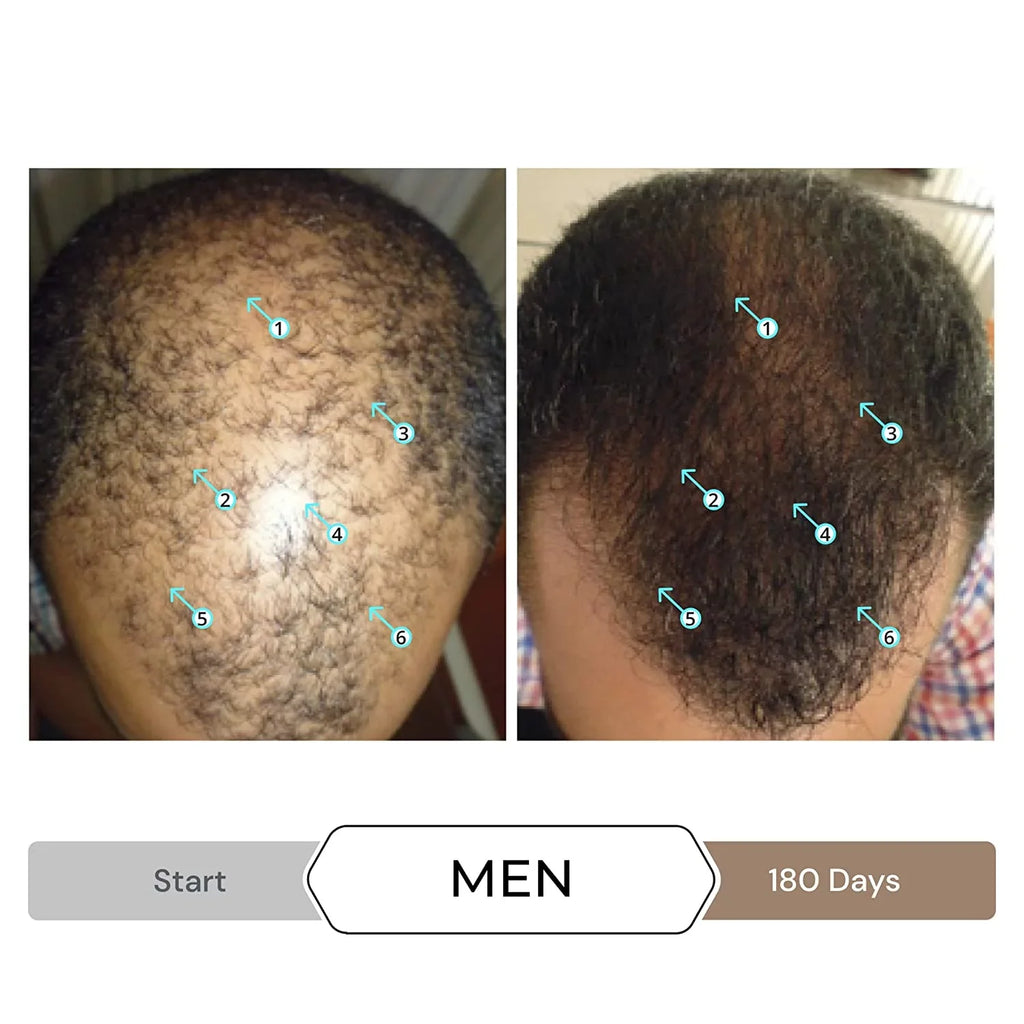 Revita Shampoo w/Biotin, Caffeine and Hair Growth Stimulating Ingredients, Helps Block DHT w/DNC-N Nanoxidil 5% Hair Regrowth Treatment